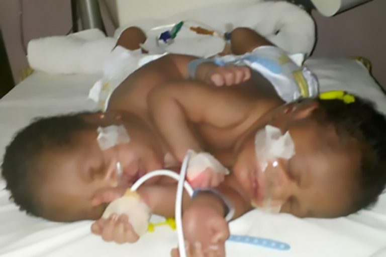 DELSUTH Co-joined Twins